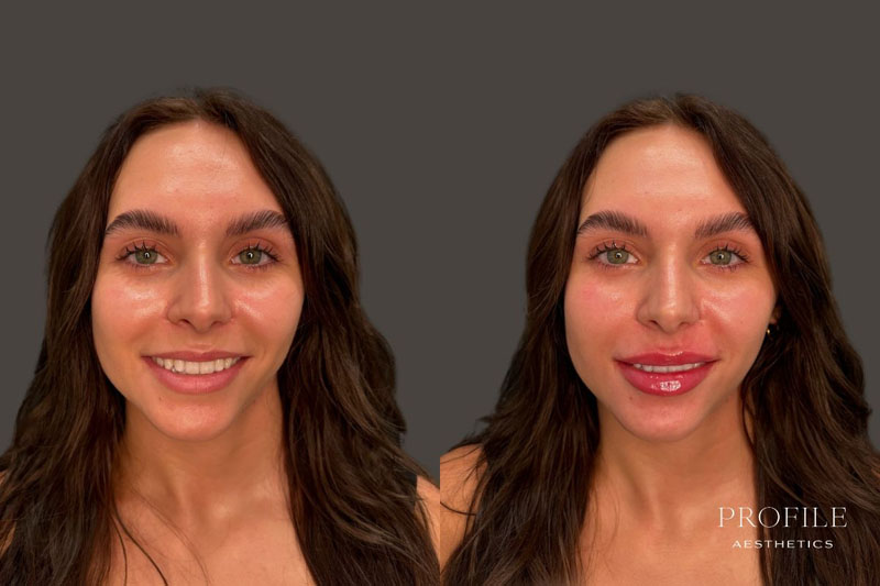 Before and After Lip Filler