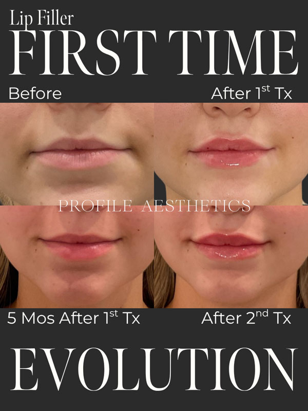 Before and After Lip Filler