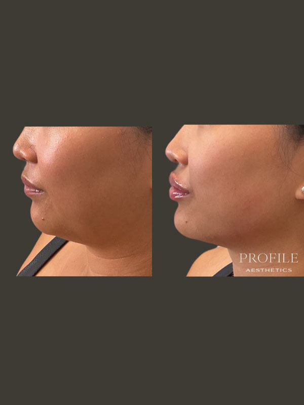 Before and After Lip Filler
