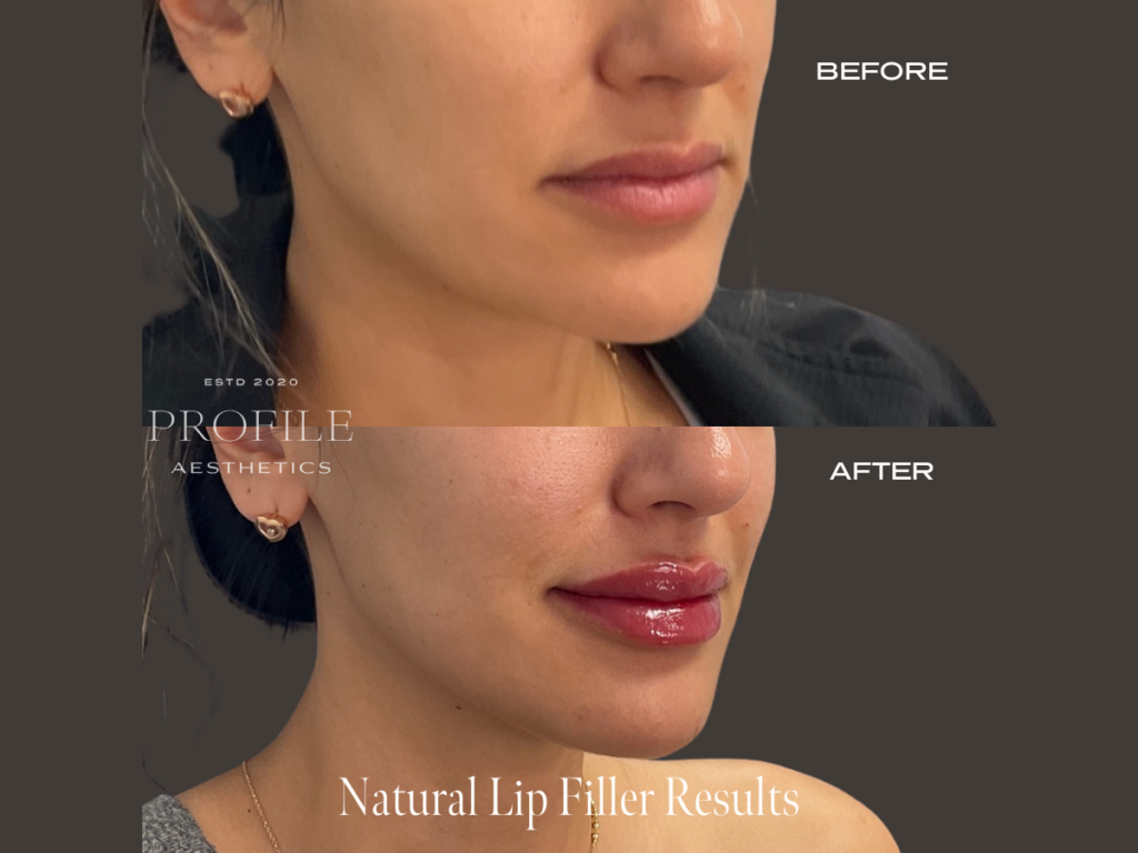 Natural Lip Filler Treatment Before and After Photo
