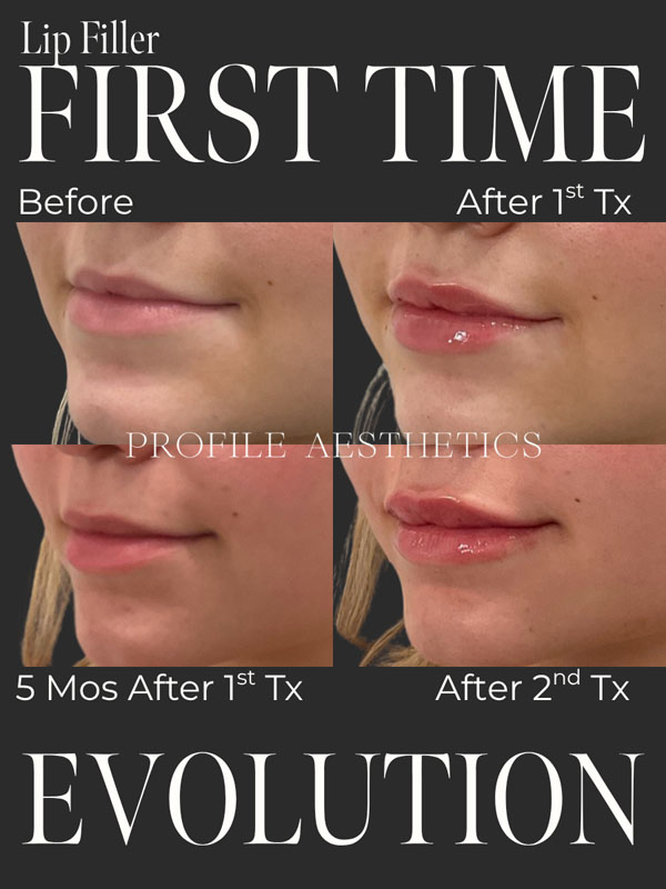 Before and After Lip Filler