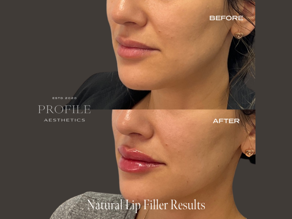 Natural Lip Filler Treatment Before and After Photo