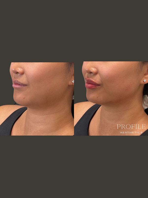 Before and After Lip Filler