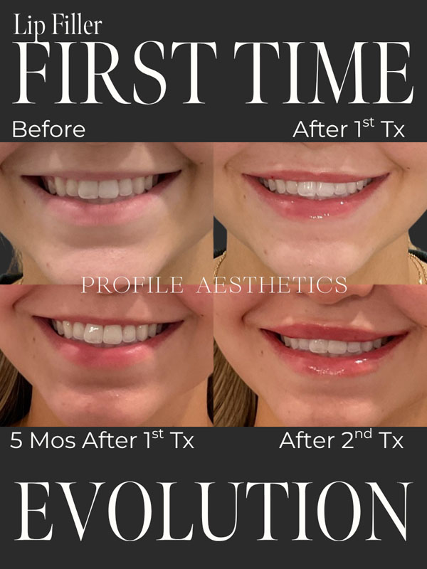 Before and After Lip Filler