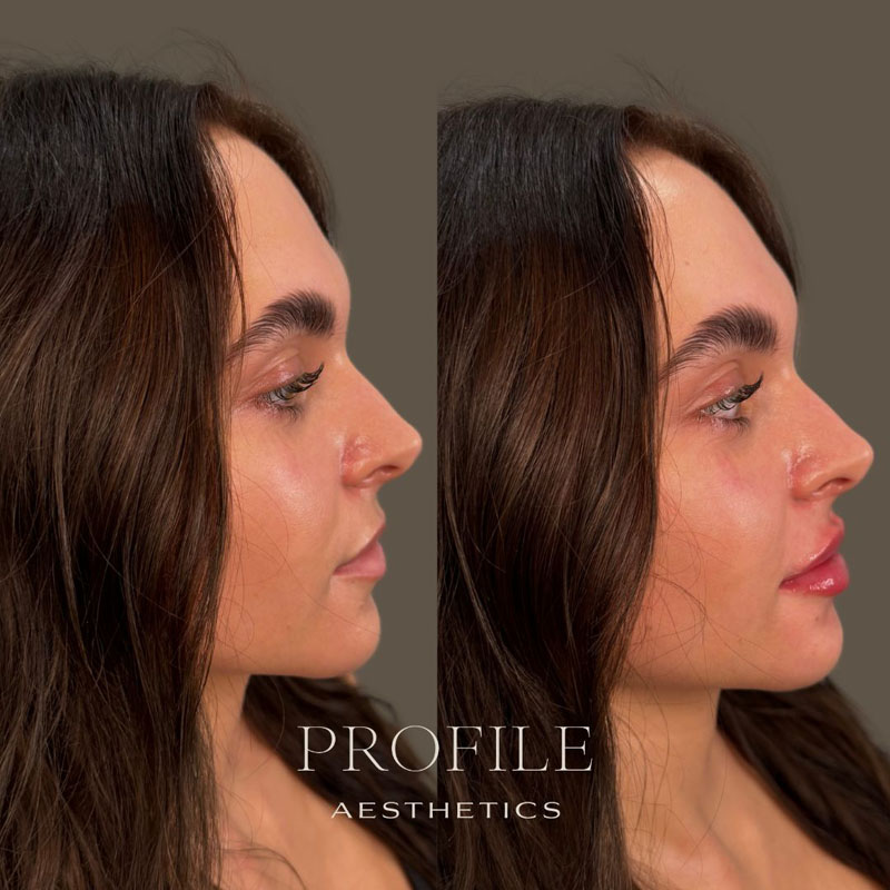 Before and After Lip Filler