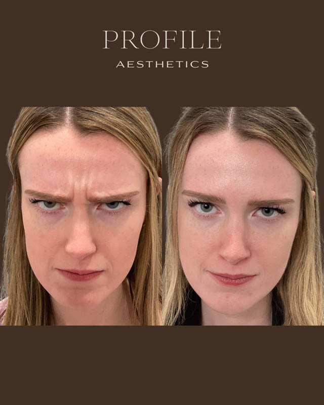 Jeuveau before and after photo