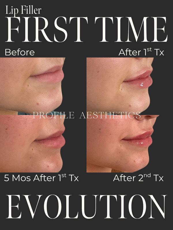 Before and After Lip Filler