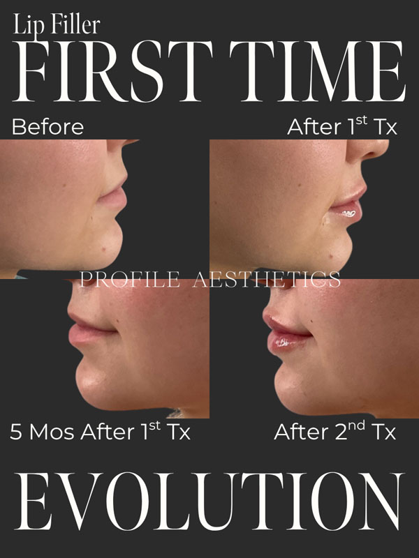 Before and After Lip Filler