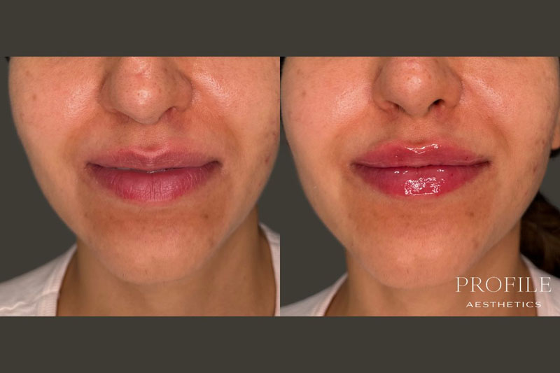 Before and After Lip Filler