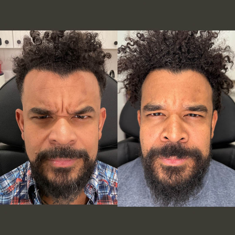 Jeuveau before and after photo