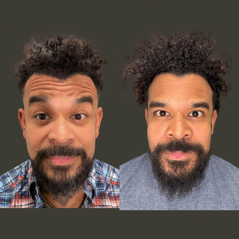 Jeuveau before and after photo