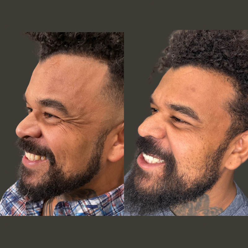 Jeuveau before and after photo