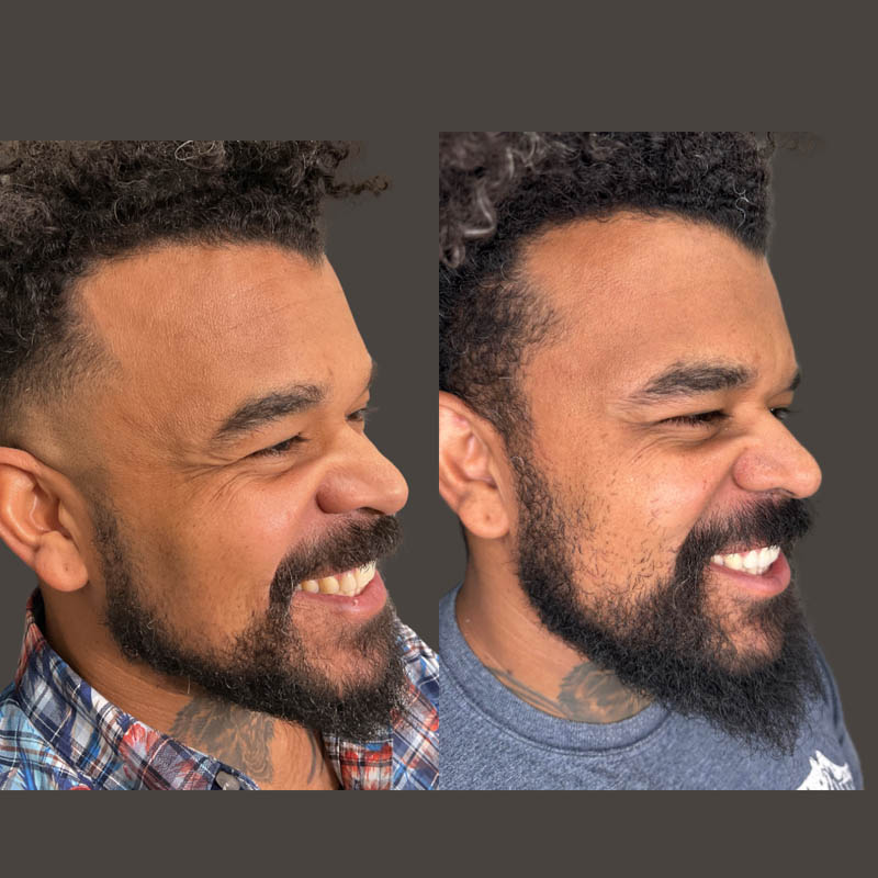 Jeuveau before and after photo