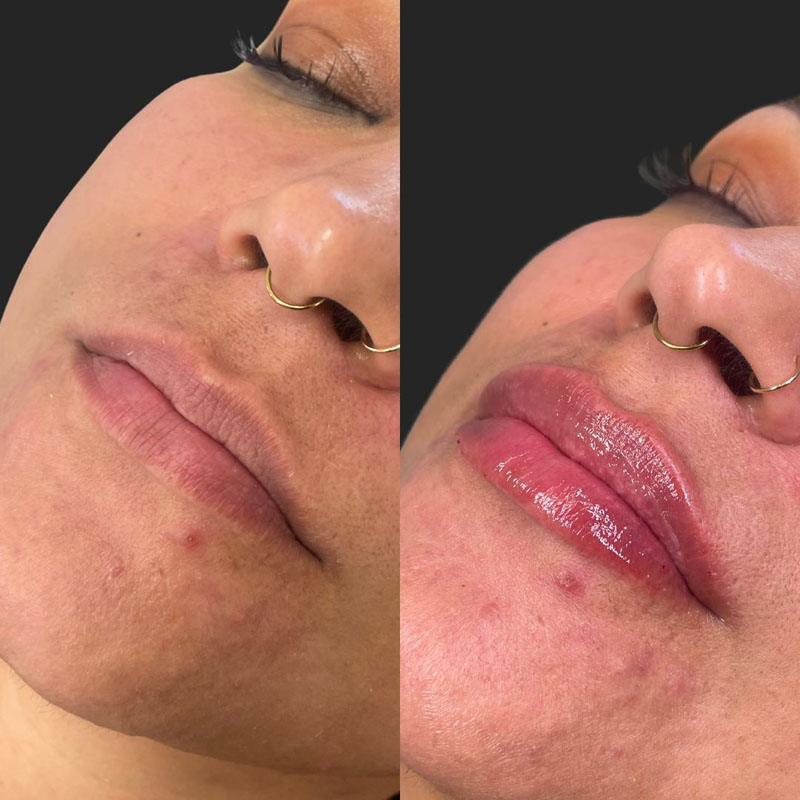 Before and After Lip Filler