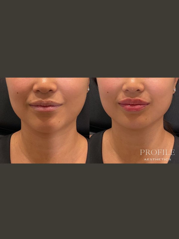 Before and After Lip Filler