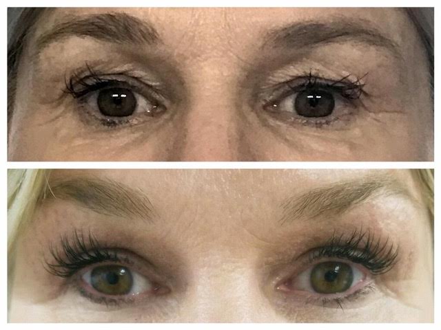 This shows a woman with eyelid skin laxity and excess that received a Sylfirm x treatment and has smoother tighter skin on her eyelids in her after photo.
