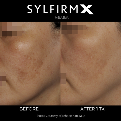 This shows a woman with melasma that received a Sylfirm x treatment and has brighter skin with less dark melasma in her after photo.