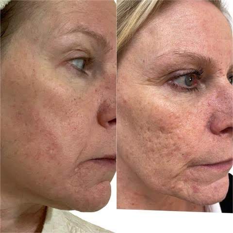 This shows a woman with acne scaring that received a Sylfirm x treatment and has smoother skin in her after photo.