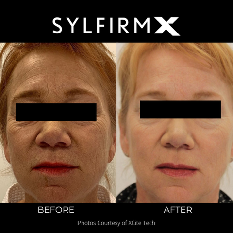 This shows a woman with wrinkles and laxity that received a Sylfirm x treatment and has smoother tighter skin in her after photo.