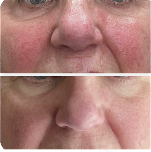 This shows a woman with redness, vascular rosecea that received a Sylfirm x treatment and has less redness in her skin in her after photo.
