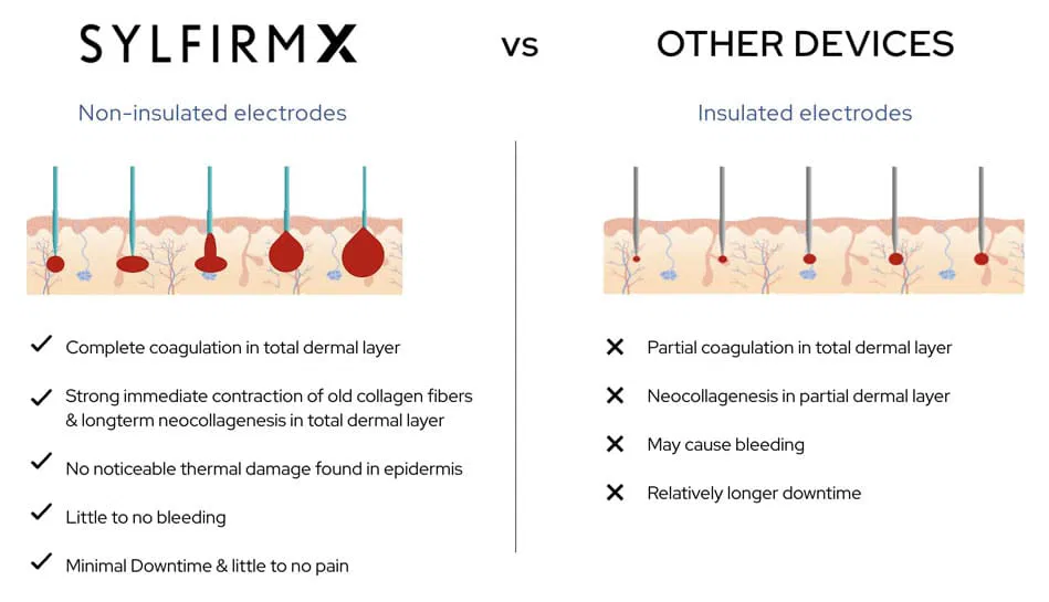 This image shows the difference between Sylfirm x and other radio, frequency, micro needling devices such as Morpheus eight. It is telling you that there is complete coagulation in total dermal layer, no bleeding, strong, immediate contractions, and noticeable thermal damage with the Sylfirm Device.